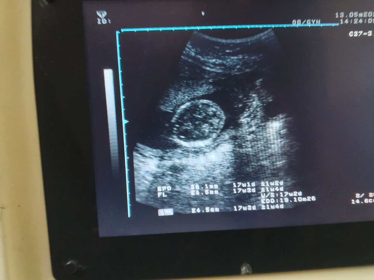 Routine ultrasound photograph of Zaibunnissa, 13 May 2026