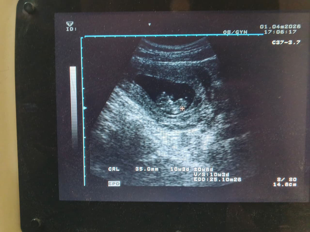 First ultrasound photograph of Zaibunnissa, 1 April 2026