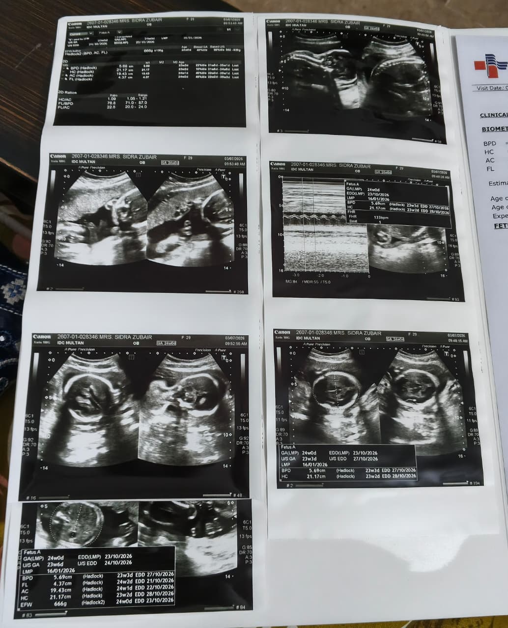 Anomaly scan ultrasound of Zaibunnissa, 03 July 2026